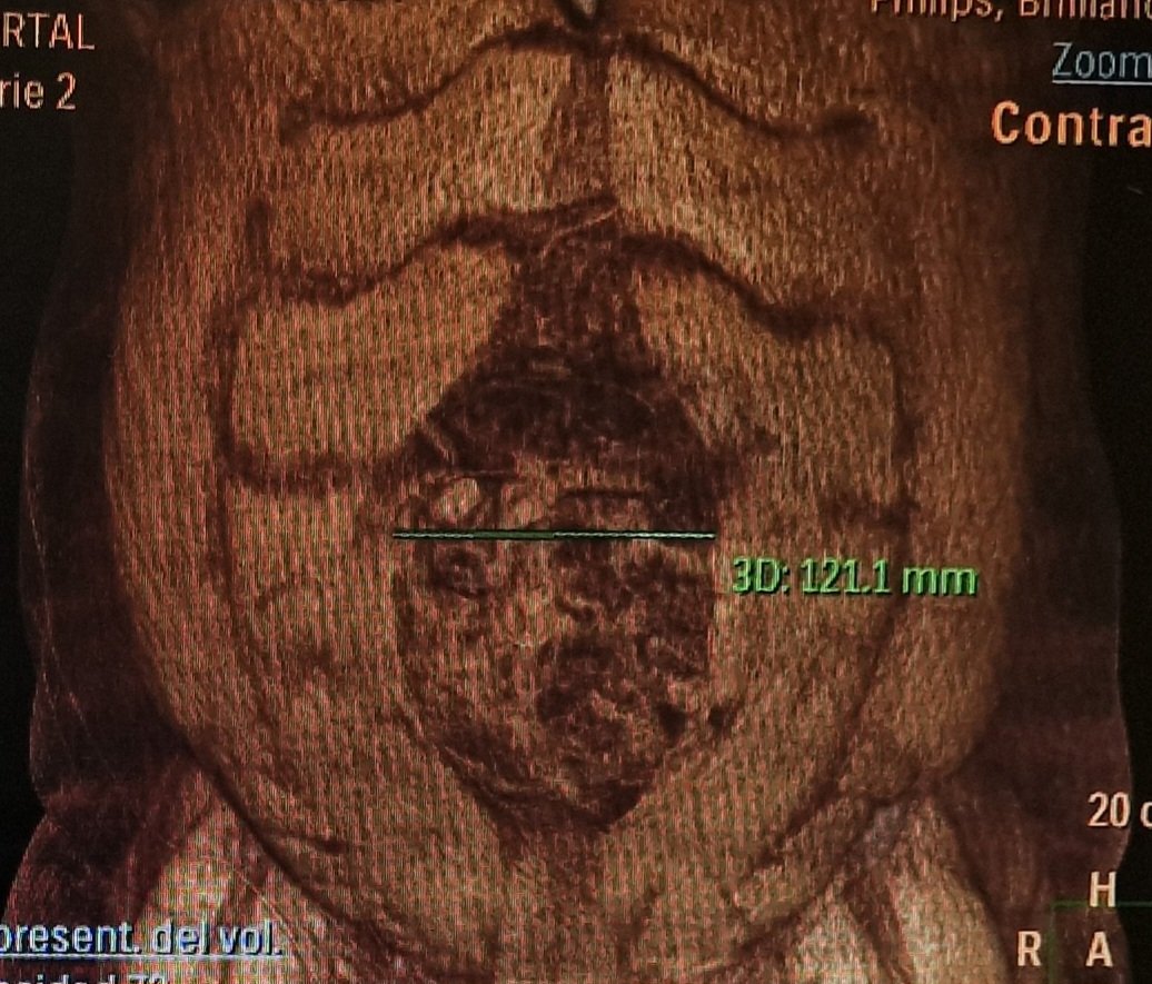CGDMedina's tweet photo. Eventración compleja de línea media M2,3,4W3(12cm), 400UI Botox 4sem previo a cirugía, ¿Cirugía y abordaje?
@pconcejoc @jrgolopez @ClaraMMM90 @JeancarTrujillo
#EVENTRACIÓN #CAWS #CMI #MIS #HERNIA #PAREDABDOMINAL #PAREDCOMPLEJA #MEDINADELCAMPO https://t.co/YoO5ncnpFA