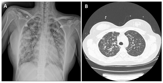 gbiondizoccai's tweet photo. Acute eosinophilic pneumonia after combined use of conventional and heat-not-burn cigarettes: a case report of concern
https://t.co/hJaSmO71t6
@InsidePMI #iqos #glo #hnbc https://t.co/4HFK3gGUd6