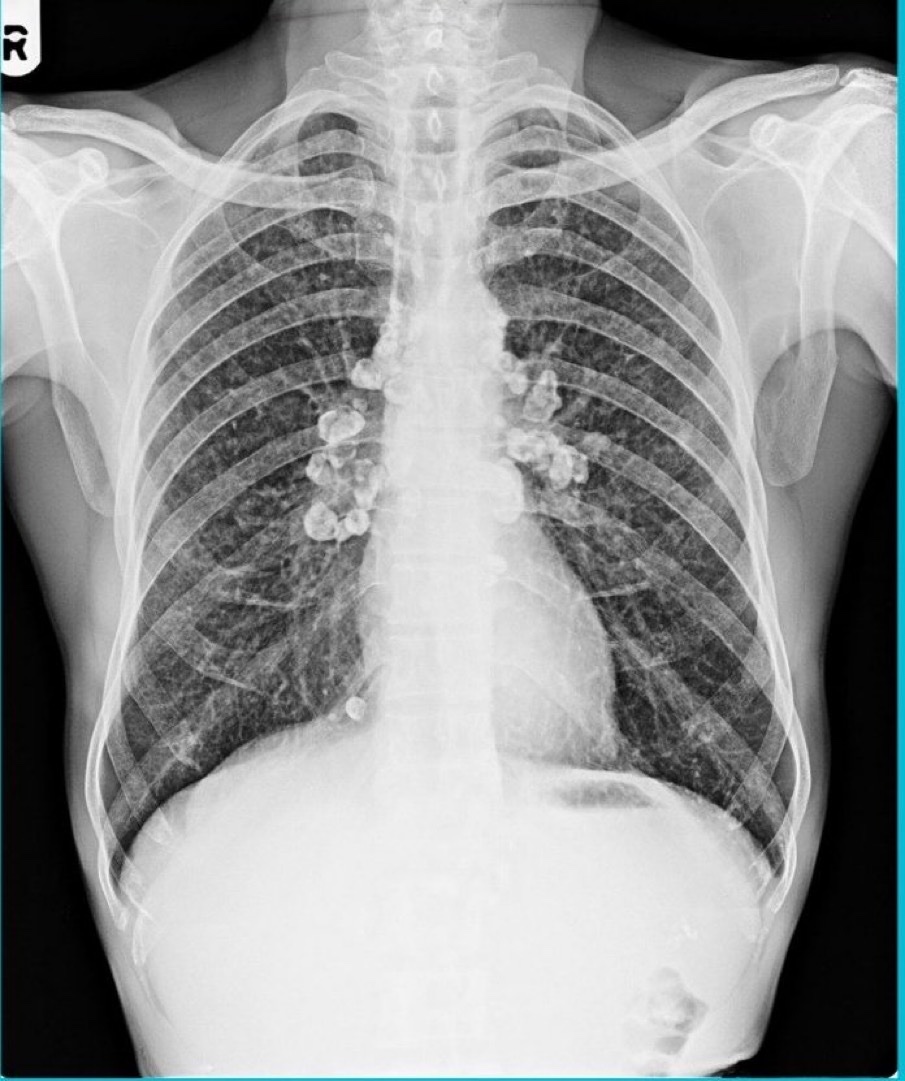 BrownJHM's tweet image. A middle aged man who worked as a sandblasting worker for many years p/w chronic cough, fatigue &amp;amp; exertional dyspnea. CXR showed these findings. What is the likely diagnosis? #MedEd #MedTwitter
