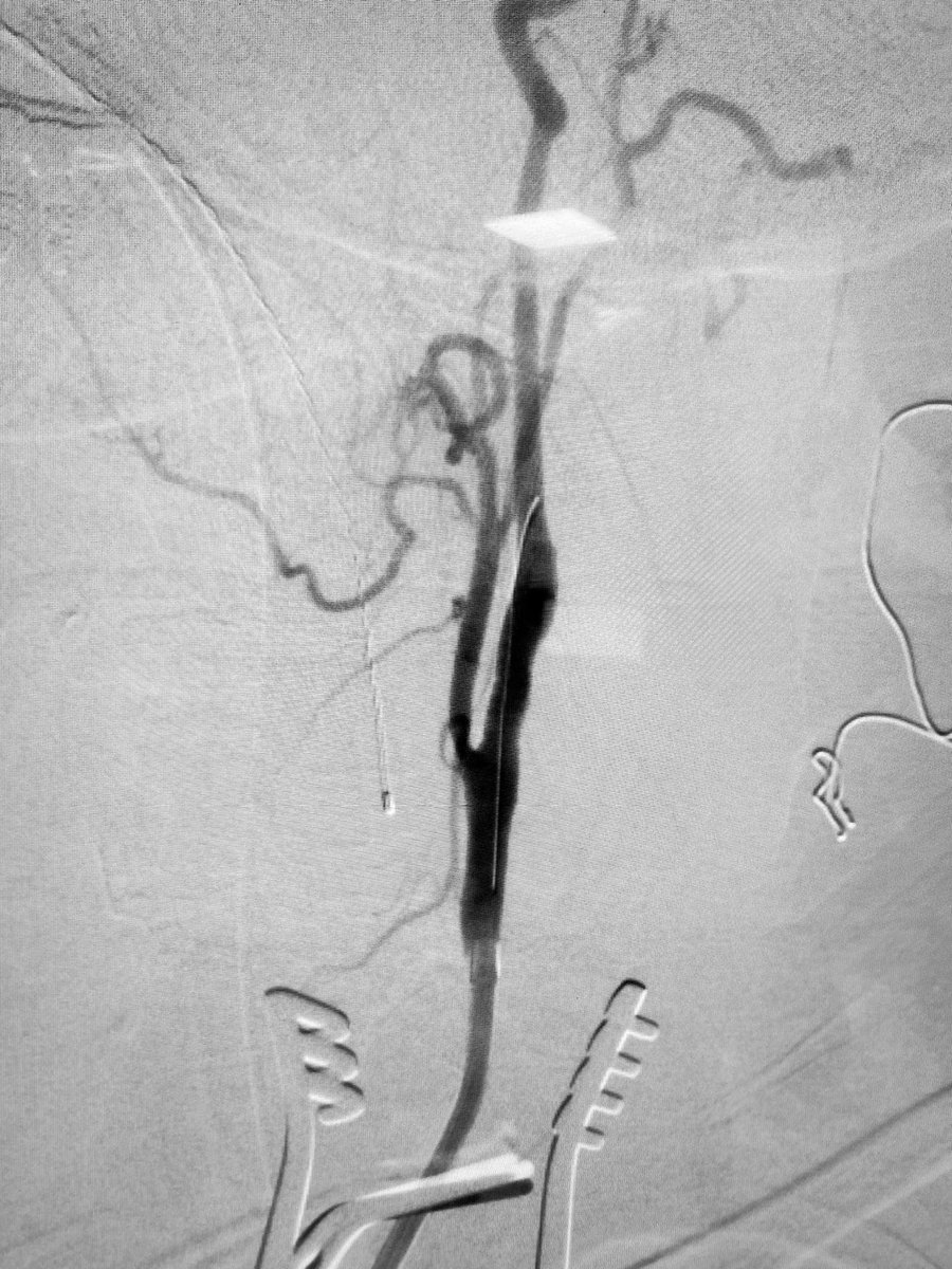 MorrisSasson's tweet photo. Exciting to bring more options and technologies to our patients! #TCAR @CleveClinicFL @HeartVasc_CCFla Thanks to @JoseNaviaMD @nbrozzimd @marianaberho @SilkRoadMed https://t.co/v05L28vqas