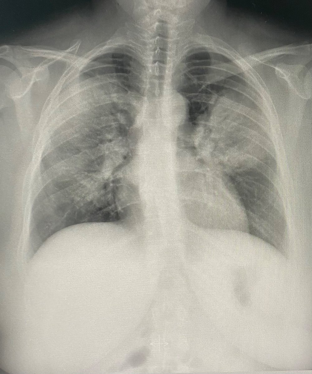 NeumologiaAvila's tweet photo. 📢HOY ES EL DÍA MUNDIAL DE LA NEUMONÍA📢
Enfermedad muy prevalente en la que el 20-40% de los casos requieren ingreso hospitalario. ¿Se puede prevenir?👇 https://t.co/7pGGuHfqsP