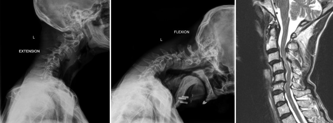 NaderDahdaleh's tweet photo. Spine case du jour: 60, F, neck pain, progressive myelopathy (UE: 3/5, LE: 4/5). BMI 14 (eating disorder), osteoporosis. 
 Diagnosis? Treatment strategy? https://t.co/tWc94q1fTi
