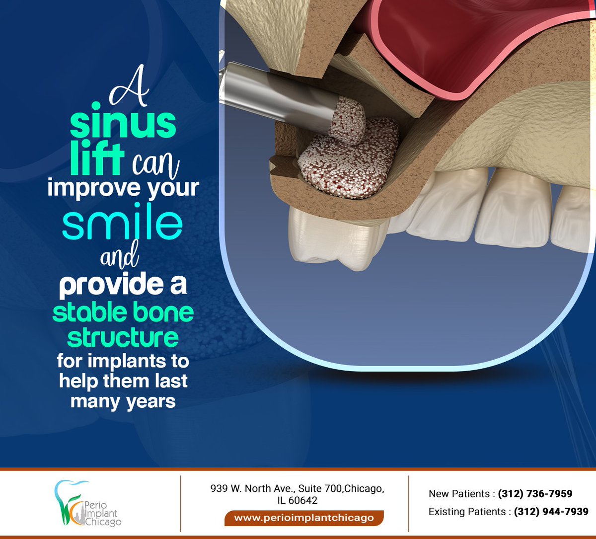 PerioImplantCHI's tweet image. Sinus augmentation, also known as sinus lift surgery, raises the sinus floor and allows new bone to develop to provide a stable foundation for dental implants. Learn more at perioimplantchicago.com #sinusaugmentation