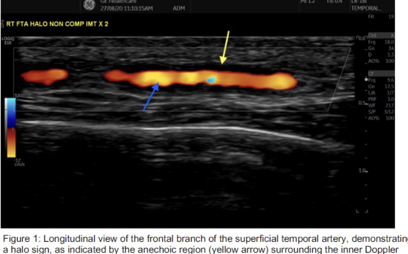 🌟Subclinical GCA in PMR🌟

👉25pts PMR
👉US of TA and AX arteries 

💥5(20%) US evidence of GCA (TA in 5/5, AX in 1/5) 
💥1yr f/up -all 5 developed clinical GCA
 
❓Time to rethink our assessment of PMR pts ❓

Abst#0478
#ACR22 @RheumNow @colmkirby22 
#ACRbest