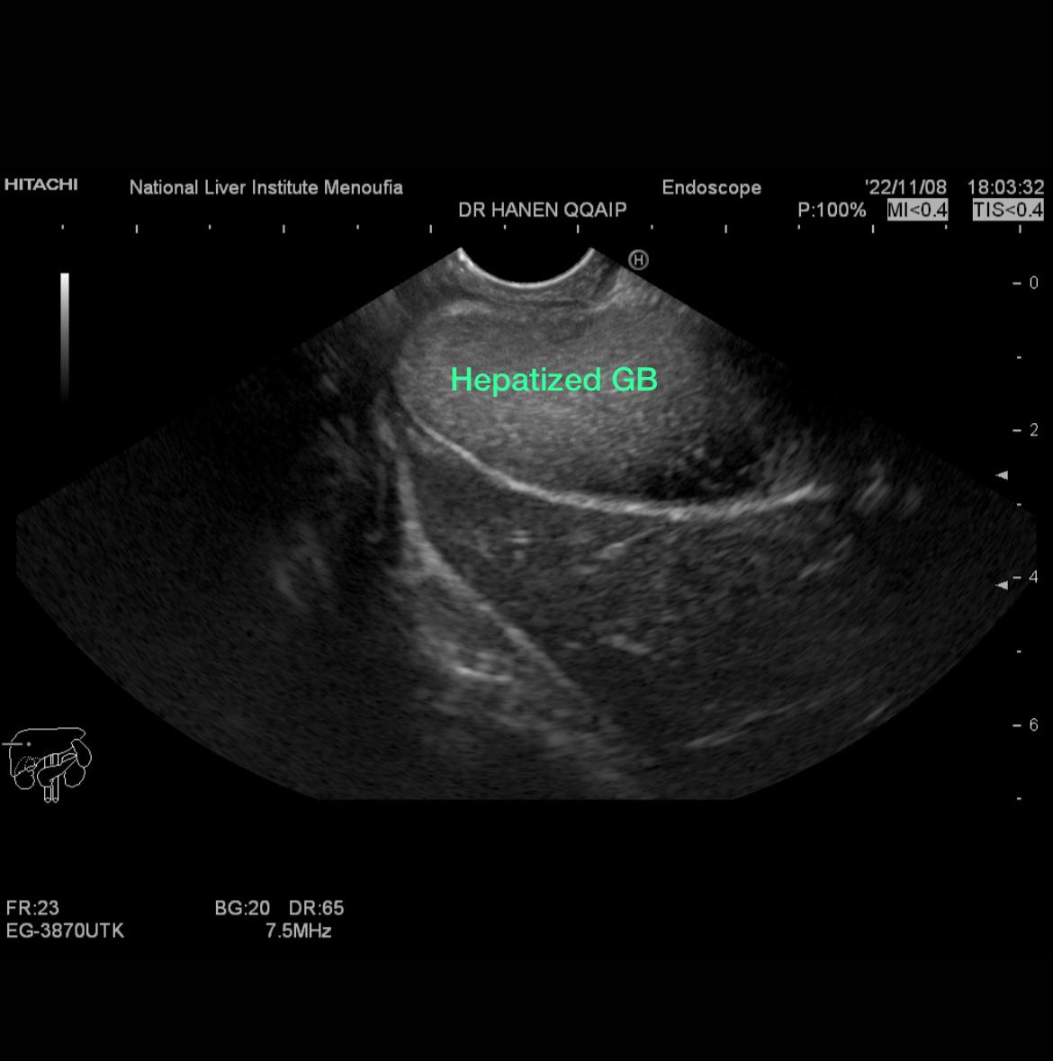 Hepatized GB in Young lady previousely diagnosed as having Crohn's ilietis ( in remission) &  presented by recurrent acute pancreatitis like pains/ negative cross imaging : Endosonography At National Liver Institute @Taalamri @KMonkemuller @neilRsharmaMD @KM_Pawlak