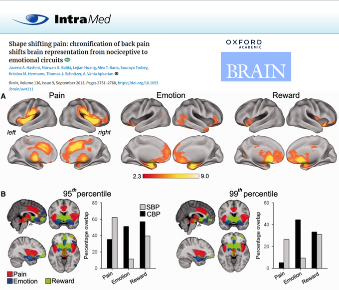 El #DOLOR CRÓNICO desafía nuestros modelos teóricos. La actividad cerebral relacionada con el dolor de espalda migra su ubicación desde las regiones del dolor agudo (sensoriomotoras) hacia los circuitos emocionales (límbicos). Se parece más a una EMOCIÓN que a una NOCICEPCIÓN.