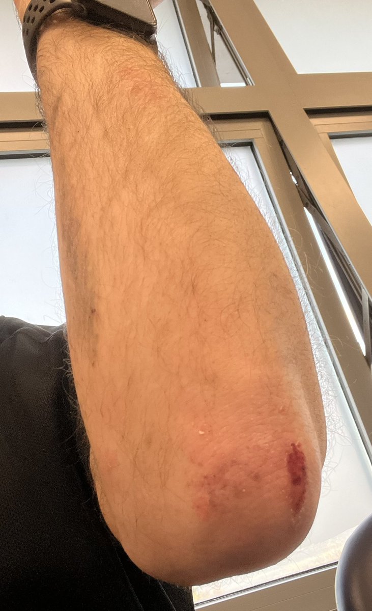 bmorgan1979's tweet photo. After a freak accident at work yesterday, don’t take every day mundane jobs for granted, communicate and plan, don’t rush. A scary moment being dragged face down along the A12 could have been avoided.
I’m fine but to fellow emergency service workers take care out on the roads. https://t.co/7seT1xbJhA