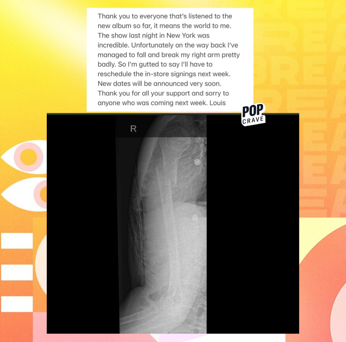 Louis Tomlinson Broken Arm