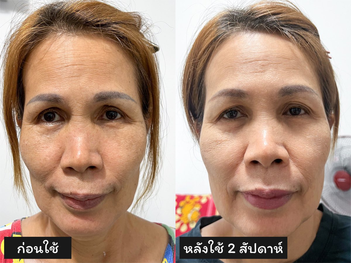 ไม่บอกไม่รู้คนอะไร 50 ยังแจ๋วผิวดีโนแอพเลยตั้งแต่ให้แม่ #sirimonaperfectingserum ขวดนี้ผิวขาว กระจ่างใส ผิวดูสุขภาพดี เนียนนุ่ม ชุ่มชื้น แถมฝ้า กระ ดูจางลงด้วย แม่ใช้ทุกวันจนผิวแม่จะดีกว่าผิวฉันแล้วนะ😂 ซื้อแบนร์ดเนมให้ก็ไม่ดีใจเท่าซื้อเซรั่มขวดนี้ให้บอกเลย555 #sirimonaskincare