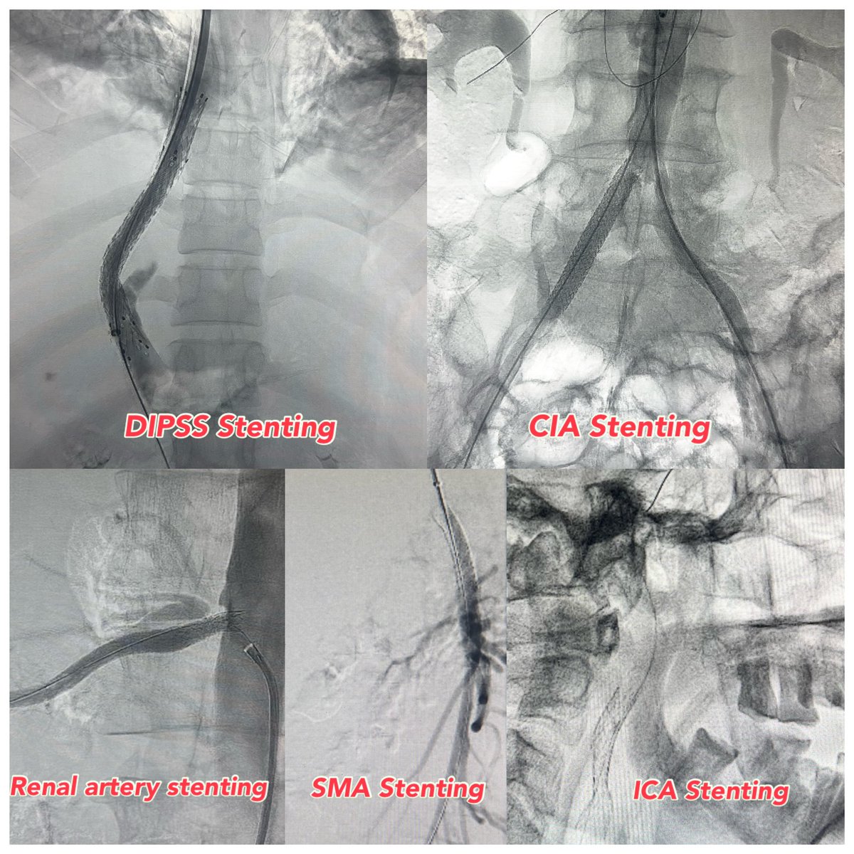 RadJodhpur's tweet photo. Spectrum of Stenting in IR
1.DIPSS - For HVOTO
2.CIA Stenting-For Peripheral arterial disease
3.Renal artery stenting-For Renal artery stenosis causing hypertension &amp;/ renal failure
4.SMA Stenting-For Chronic Mesenteric Ischemia
5.ICA Stenting-ICA stenosis with TIA https://t.co/JJ6JTZicP7