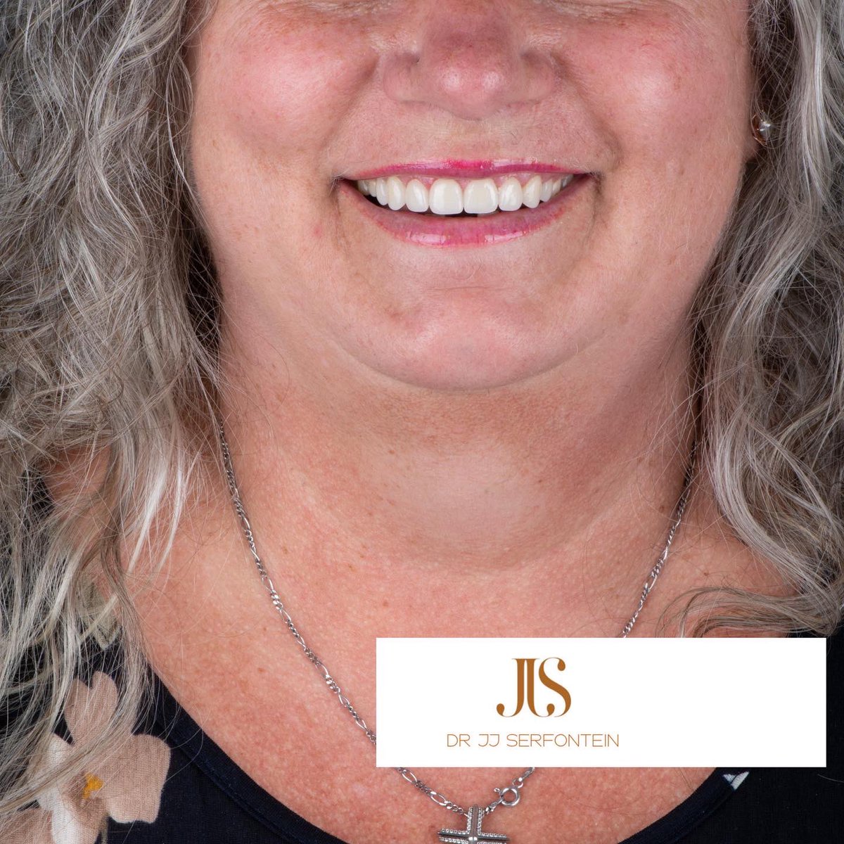 Love this new smile!
#smilethewayyouwant #smilemakeover #jjsdentistry #drjjserfontein