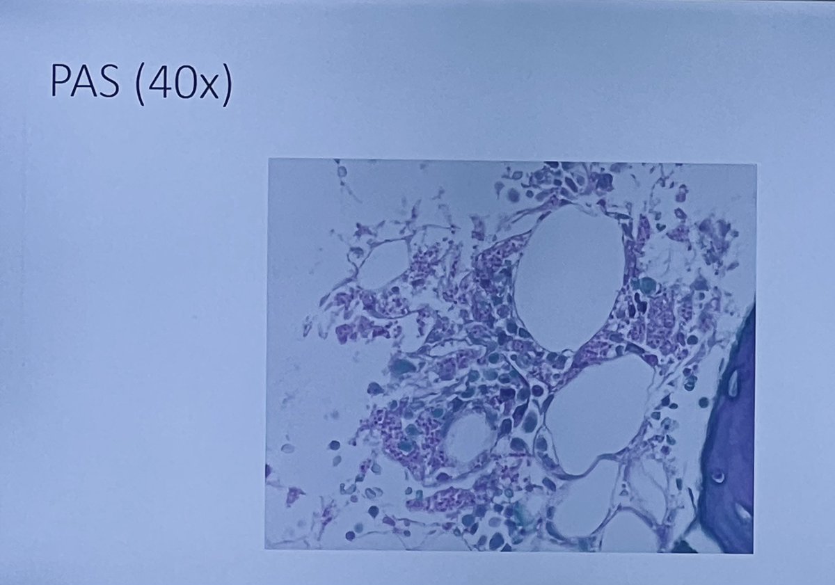 ID/Pathology/Micro rounds. Case of disseminated #histoplasmosis. Bone marrow biopsy.  H&E, GMS and PAS 🔬🧫 #IDTwitter #MedTwitter #IDFellowship @ECU_Pathology