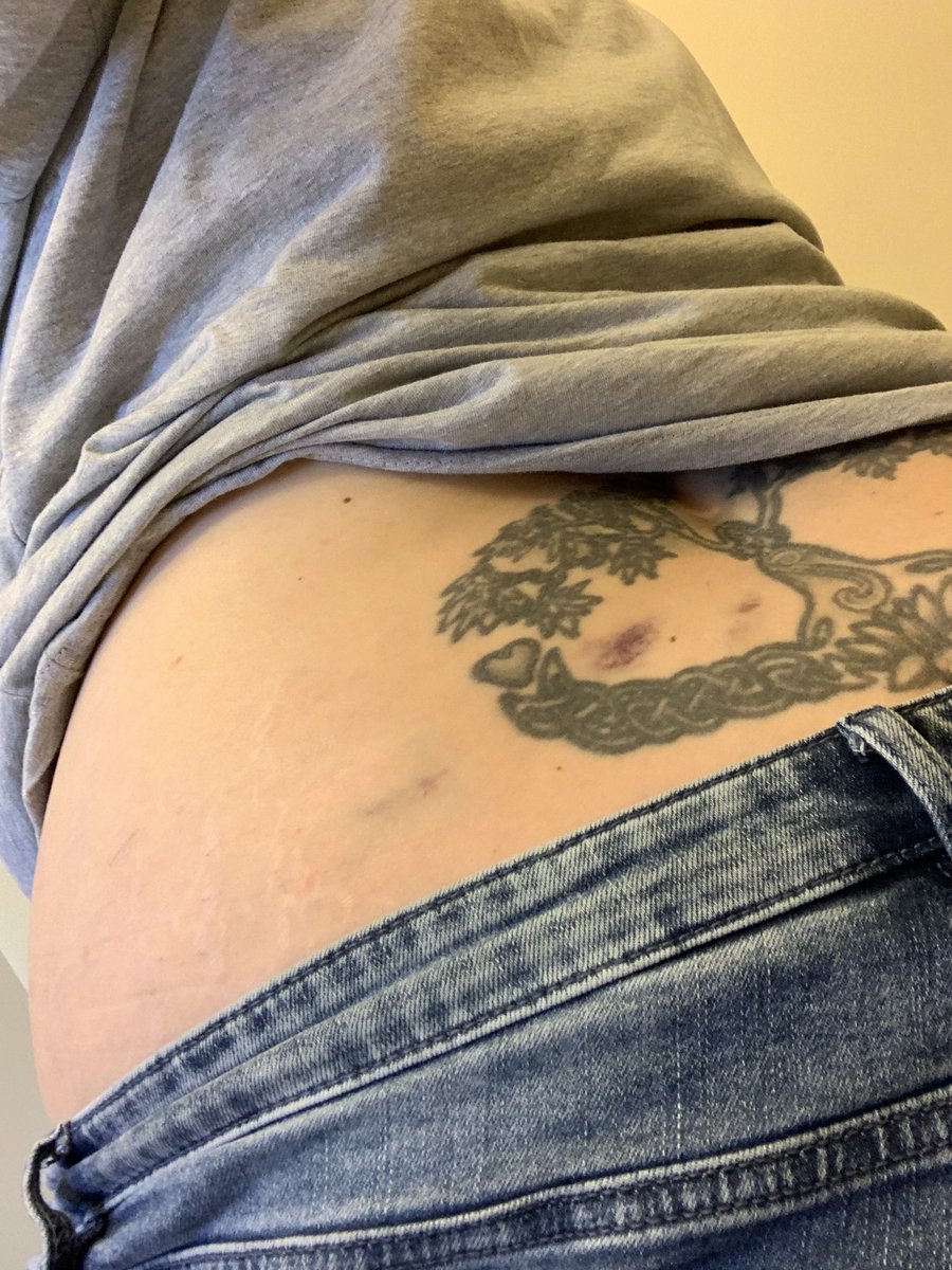 Lizzibear's tweet photo. Last week we tried lumbar spine injections. I noticed a huge improvement in my pain so we went for the neck and trapezoids today. π¬ #spineinjury #triggerpointinjections #cortisone #anesthetic #slipandfall @meijer still hasnβt compensated me for my injury due to their negligence https://t.co/SX5u4wVgDv