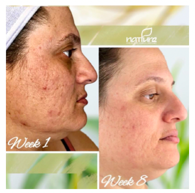 Address texture.  Address tone.  Clear acne.  Holistically 🌱 with @naturepurelabs  Clinical Skin Care.  The Nature Pure Acne Corrective Treatment is formulated to correct hormone-related acne by treating the root cause.  Get your entire guide, plus protocol, by tapping the lin