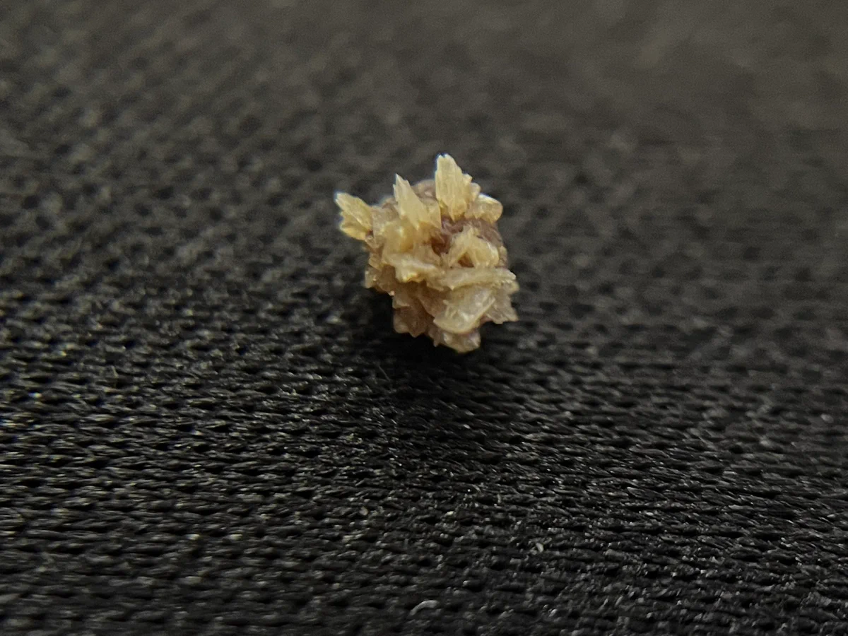 見るだけで痛そう！自然排出された尿管結石がこちら！