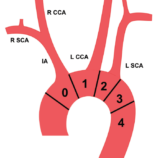 ETF_IRtrainees's tweet photo. 📚 The proximal landing zones in #TEVAR are numbered 0-4. When the pathology requires placement of the stent graft in zone 0, 1 or 2, a plan for #revascularisation of the arch vessels is needed. This article describes different debranching techniques: 

➡️ https://t.co/WpBCyHZ5u7 https://t.co/uOjadL00mw