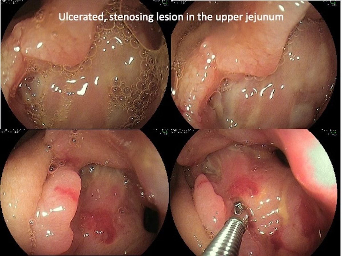 EndoCollab™ | GI Endoscopy Community tweet media