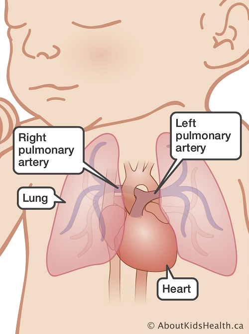 AboutKidsHealth's tweet photo. Pulmonary hypertension is very rare in children, but it is serious.
Because it is so rare, it can go undiagnosed for a long time. Other conditions that may result in pulmonary hypertension incl: https://t.co/gQbZXWeL5c
#PHAwareness #LifeInPurple https://t.co/ZBCEWzREtU