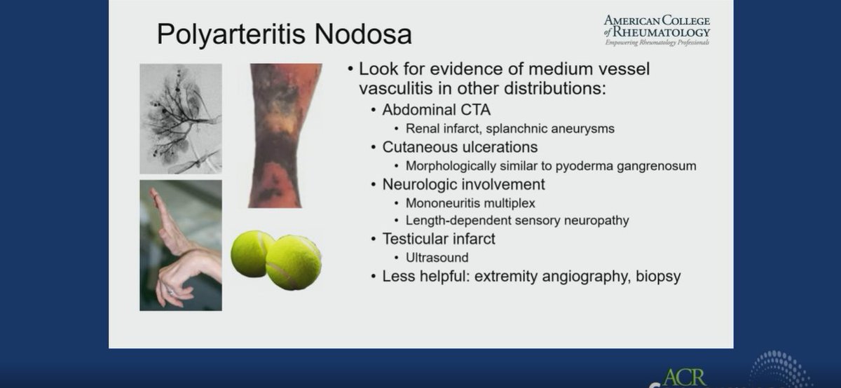 debaditya_roy's tweet photo. 💫#By Dr.Philip Seo
#PAN #Polyarteritis Nodosa 
🔬In your search with digital ischemia🔥
🔎Go skin-deep... &amp; by that not just Skin Biopsy!

✅Look for evidence in other organs
✅Dont forget testicular infarct
✅Biopsy/Angiography may not be helpful

#ACR22 #ACRambassador @ACRheum https://t.co/pk9MkW7drD
