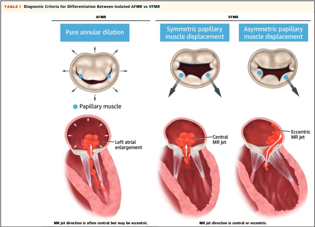 JACC Journals (@jaccjournals) on Twitter photo Don’t miss this #JACCIMG imaging expert panel viewpoint on atrial functional #mitral regurgitation ➡️ bit.ly/3TgU0l6
#cvImaging #echofirst #whyCMR #cvVHD #vhdMR <a href="/WilliamZoghbi/">WilliamZoghbi</a> Don’t miss this #JACCIMG imaging expert panel viewpoint on atrial functional #mitral regurgitation ➡️ bit.ly/3TgU0l6
#cvImaging #echofirst #whyCMR #cvVHD #vhdMR <a href="/WilliamZoghbi/">WilliamZoghbi</a>