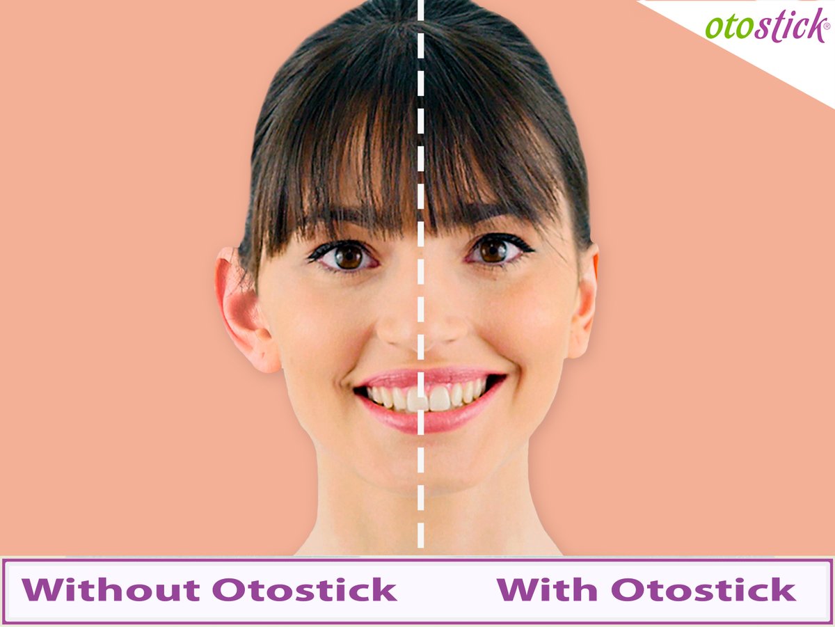 Otostick_UK's tweet photo. Reduce the appearance of prominent ears effectively and discreetly - without surgery.
Buy Otostick here: https://t.co/sgDt9QjWtT
#prominentears #otoplasty #earcorrector #otostick https://t.co/OJd11477oQ