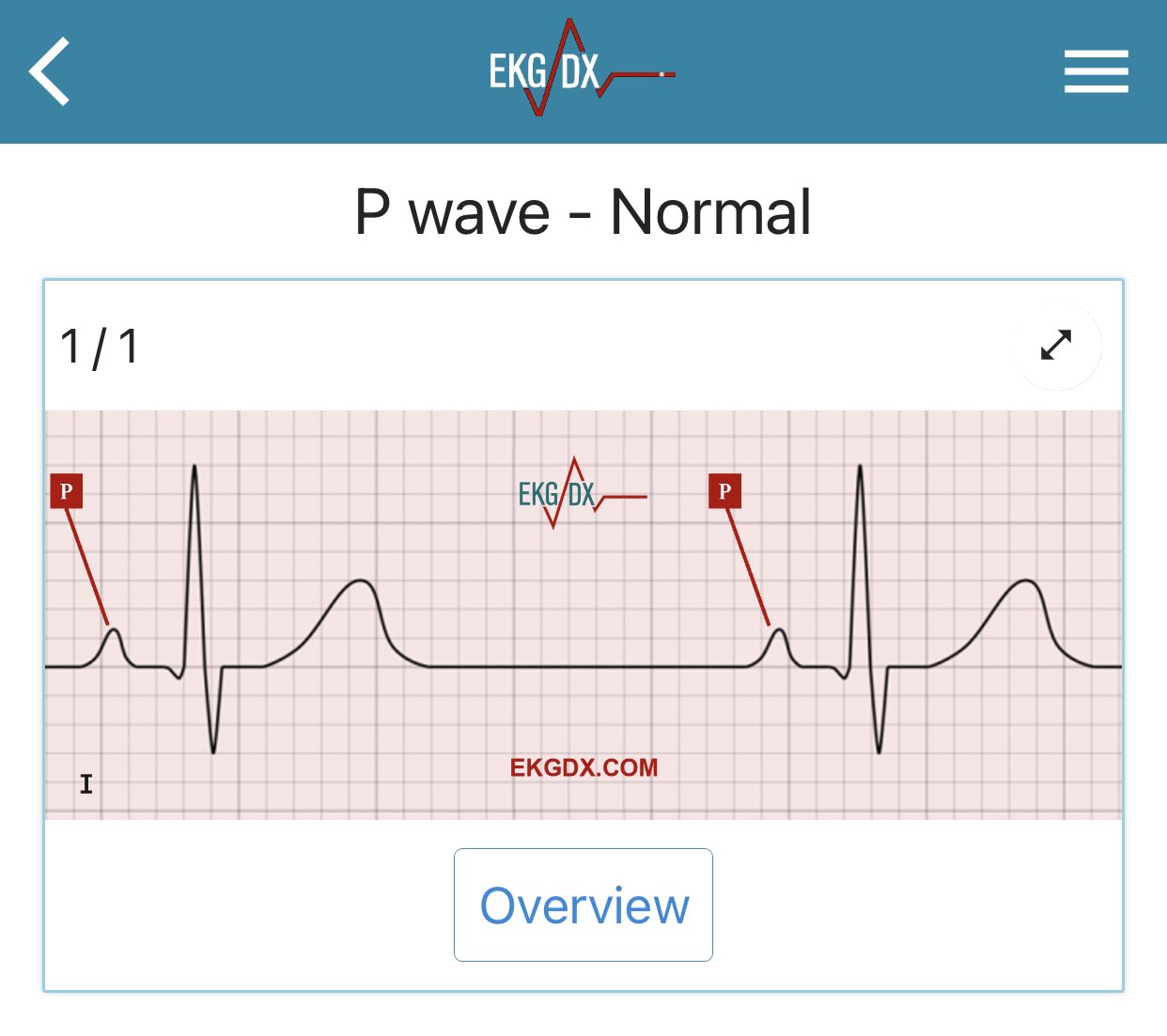 What Is A Peaked P Wave