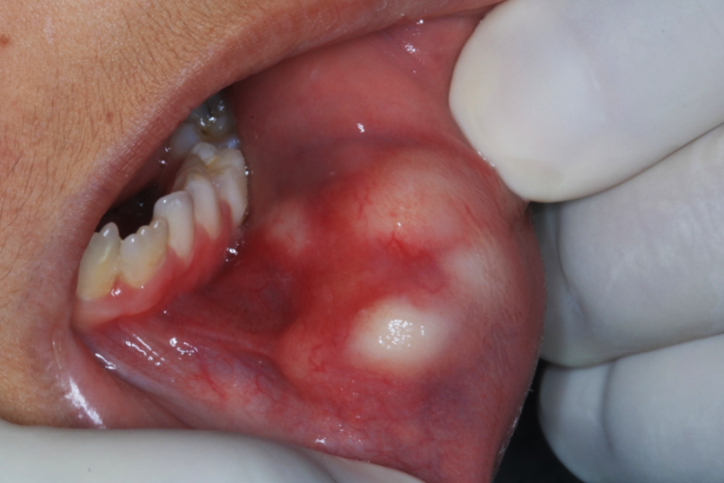 PenafortPaulo's tweet photo. Low-Grade Fibromyxoid Sarcoma in the labial mucosa of a pediatric patient. The tumour cells were positive for Vimentin, CD99, BCL-2 and showed strong cytoplasmic positivity for MUC4. See this case at https://t.co/Z2HuL6G1iR https://t.co/nZWtcaeBau