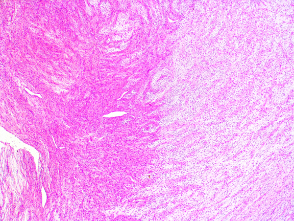 PenafortPaulo's tweet photo. Low-Grade Fibromyxoid Sarcoma in the labial mucosa of a pediatric patient. The tumour cells were positive for Vimentin, CD99, BCL-2 and showed strong cytoplasmic positivity for MUC4. See this case at https://t.co/Z2HuL6G1iR https://t.co/nZWtcaeBau