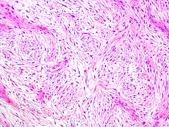PenafortPaulo's tweet photo. Low-Grade Fibromyxoid Sarcoma in the labial mucosa of a pediatric patient. The tumour cells were positive for Vimentin, CD99, BCL-2 and showed strong cytoplasmic positivity for MUC4. See this case at https://t.co/Z2HuL6G1iR https://t.co/nZWtcaeBau