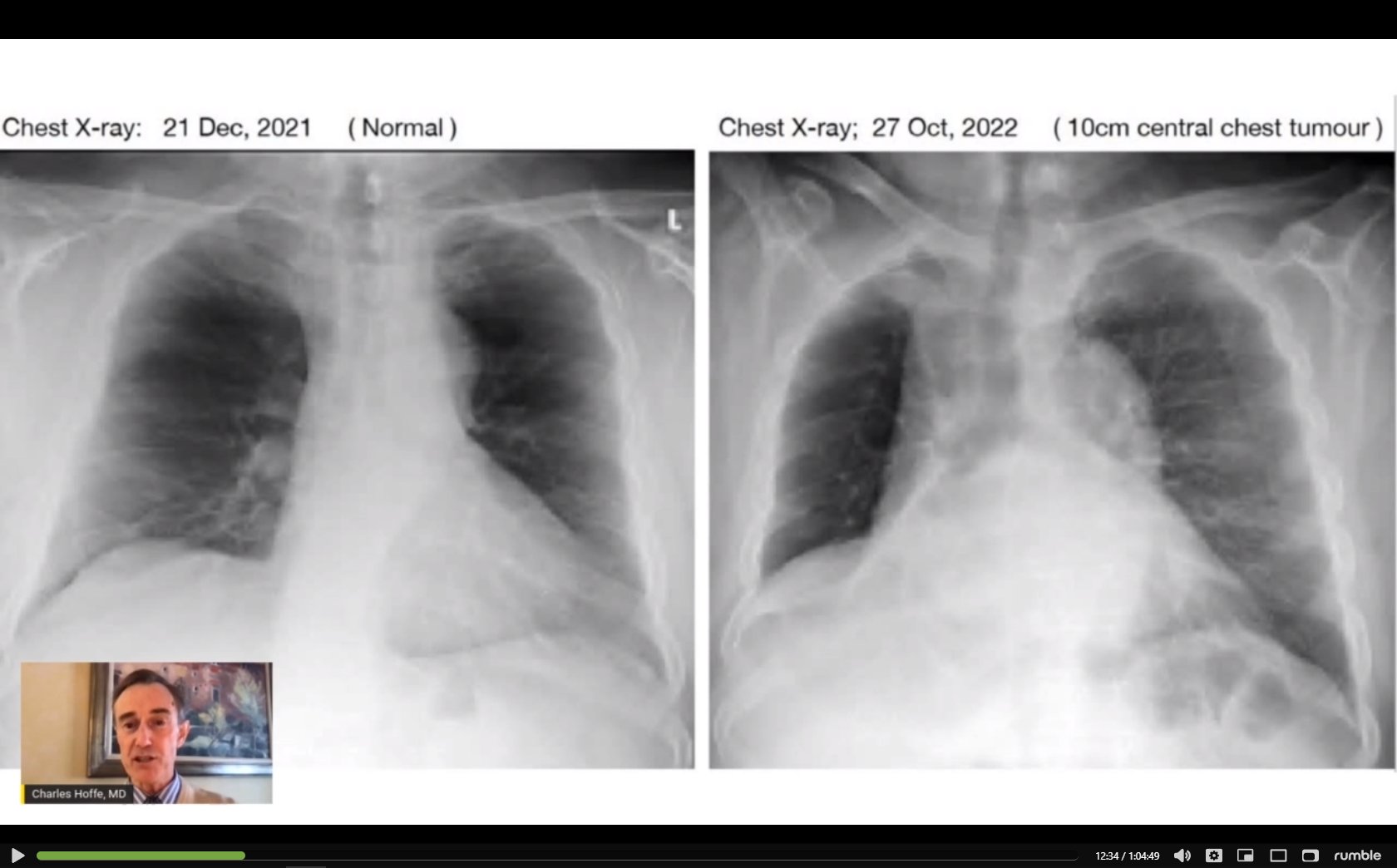 Triss Tone On Twitter look How Big That Tumor Got And How Quickly triss-tone-on-twitter-look-how-big-that-tumor-got-and-how-quickly
