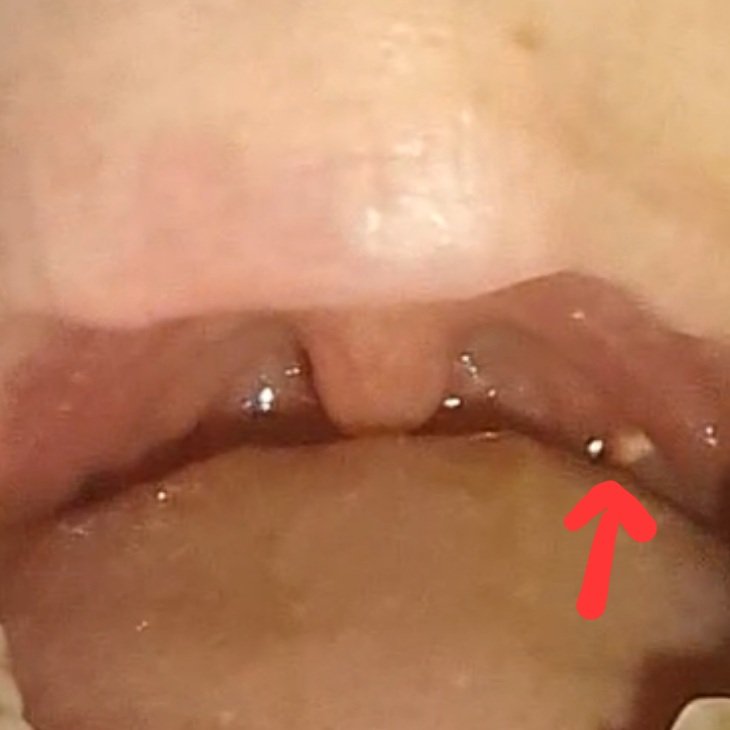 palmerdebra's tweet photo. I just want to start feeling better! Geez! It's been 3.5 weeks since I had Covid and I have yet to feel 100% better!! And because I still have been coughing and sneezing, I now have a tonsil stone. Second pic is of my tonsil stone. #tonsilstone https://t.co/J3pFic37Ag