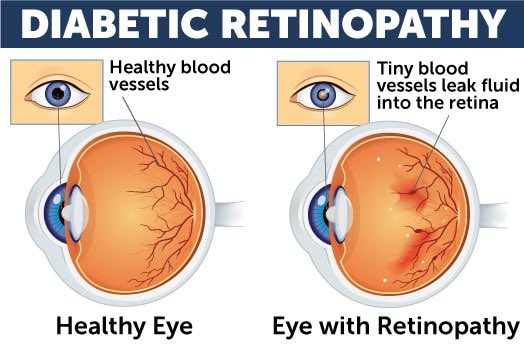 ErnaOptom's tweet photo. “World Diabetes Day, 14th of November”  1 in 10 adults is living with diabetes and according to the World Health Organization, close to 1 million are blind due to diabetic retinopathy.
If you have Diabetes and feel that your eyesight has been affected, book an eye exam today! https://t.co/f9SpsgpWs9