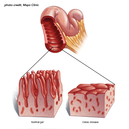 TheCeliacScene's tweet image. 🙏 Hope on the horizon! Experts develop 10 diagnostic criteria &amp;amp; management strategies for un-resolving Celiac Disease. SEE bit.ly/3URlUVV  #celiacdisease #refractorysprue #nonresponsive #rcd #rcd1 #rcd2 #villousatrophy #diagnostic #criteria #clonaltcell #tcell #lymphoma