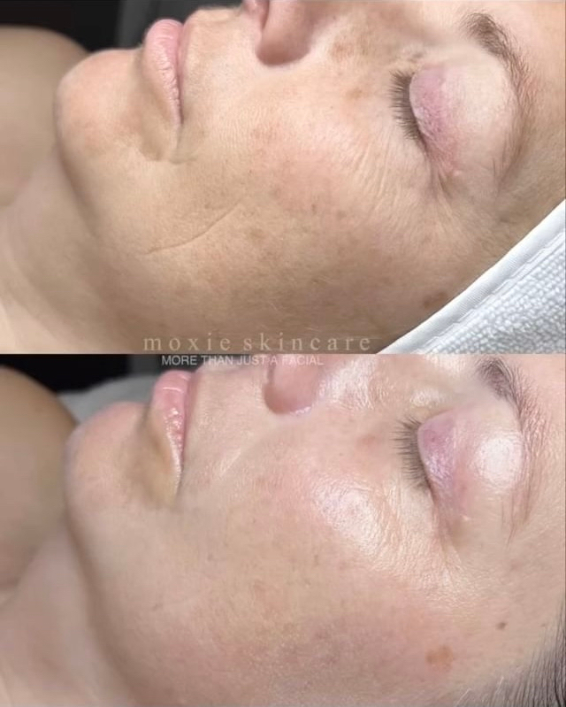 @moxieskincare @dmkinternational 

Detoxed, bright, smooth, plump, hydrated, and ✨✨✨ GLOWING ✨✨✨
after an Ultra Hot/Cold Therapy Treatment and DMK MD™ + Soothing &amp; Hydrating Occlusive Mask!

#dmkskin #ifounddmk GetMoxied #MoxieSkincare #MoreThanJustAFacial #DMKSkin