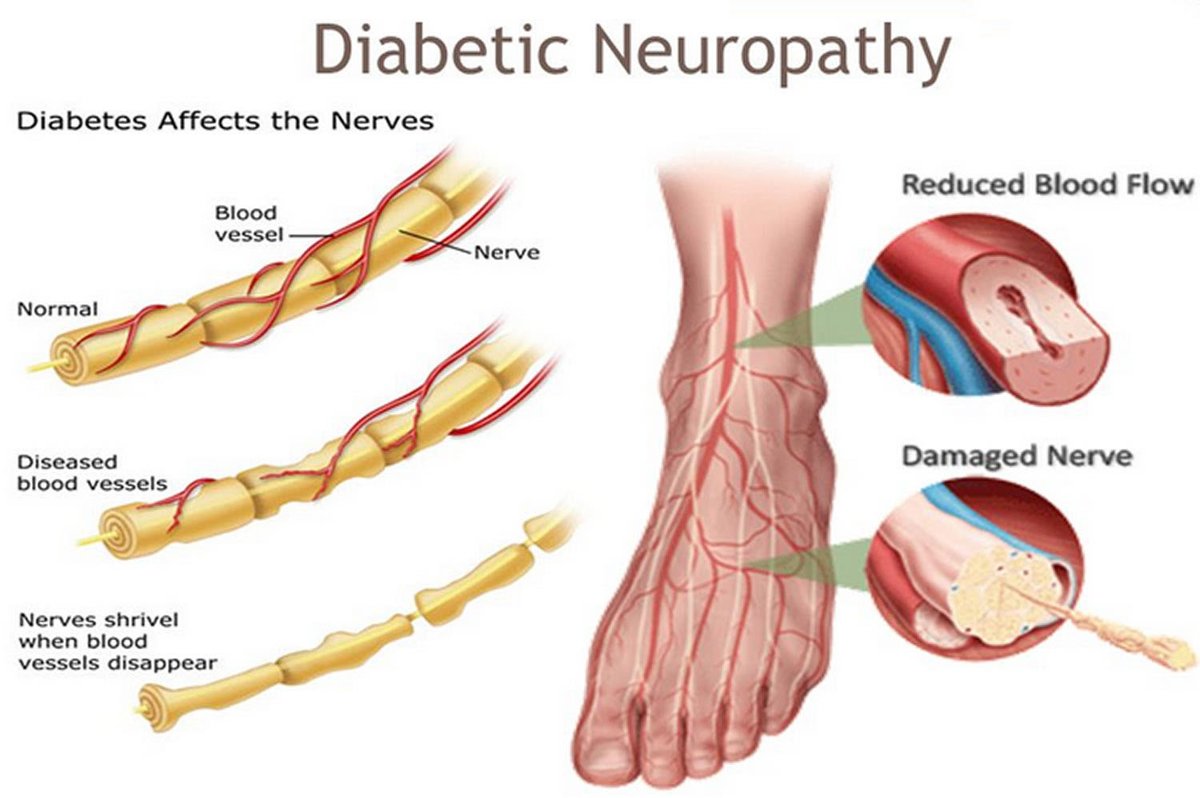 #Diabeticperipheralneuropathy is a chronic complication of diabetes mellitus which causes #lossofsensation. 
@Infogujcost supports R&D projects through #STIPOLICY which intends to develop a novel device which will detect the level of DPN via
#ElectrophysiologicalStudy 
#wdd2022