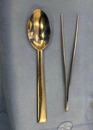 Ron Barbosa MD FACS (@rbarbosa91) on Twitter photo 🧵on the spoon as a surgical instrument.
(inspired by a post by <a href="/SKhalilMD/">SusanKhalil, MD, MS, FACOG, FACS</a> and its replies)
By this I don't mean curettes or spoon-like instruments...I literally mean an actual kitchen spoon, as it has been used during real surgical operations. 🧵on the spoon as a surgical instrument.
(inspired by a post by <a href="/SKhalilMD/">SusanKhalil, MD, MS, FACOG, FACS</a> and its replies)
By this I don't mean curettes or spoon-like instruments...I literally mean an actual kitchen spoon, as it has been used during real surgical operations.