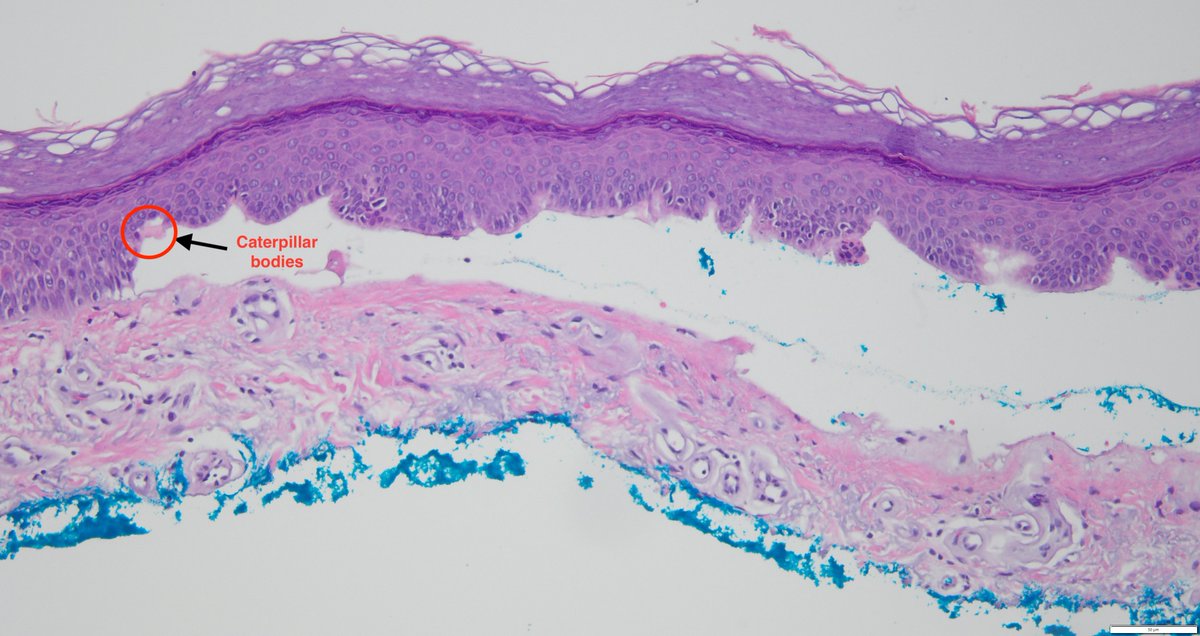 A case of Porphyria Cutanea Tarda showing a sub-epidermal split with minimal inflammatory infiltrate. There is subepidermal festooning and associated hyalinization of the upper dermal vessels. Scattered Caterpillar bodies on the epidermal side of the split are also seen.