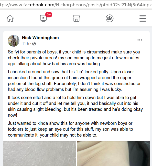 TheGuardianAn15's tweet photo. #BabyCutter's PA provides a terrific opportunity for education. He and his friends don't like the truth, though.
https://t.co/ic51u2WNpw
#BornPerfect #Circumcision #Complications #HairyShaft #Genital #mutilation #cutting #CulturalPerversion #Medical #fraud #malpractice #fraud https://t.co/Pg3wubRVa5