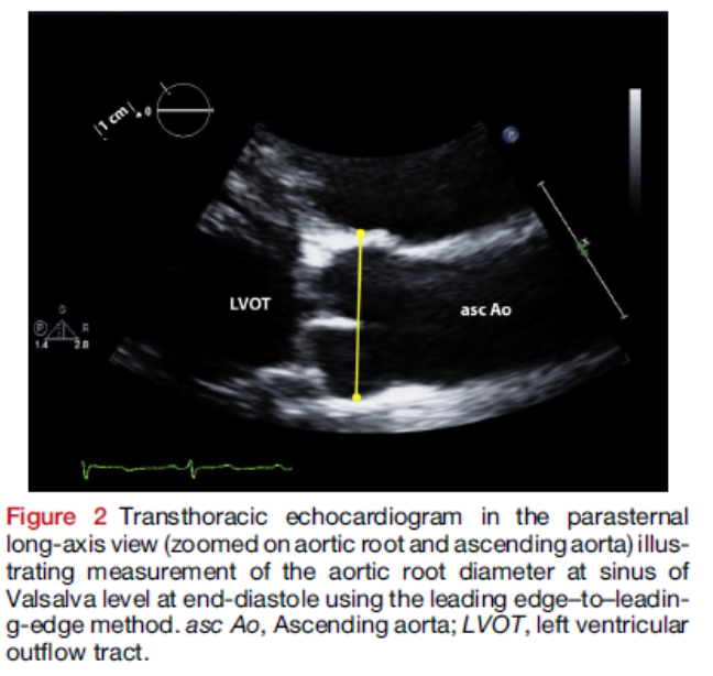 EGarciaSayan's tweet photo. 5/ How do we measure SOV?
🔺Remember #EchoFirst measurements in PLAX &amp; end-diastole perpendicular to long axis of Ao from leading edge to leading edge (≠ CT/CMR)
🔺Consider age, BSA, gender &amp; standardize in your lab. 
🔺3 methods at your fingertips w/ new @ase360 #EchoGuide App https://t.co/OjvuQ0mNjH