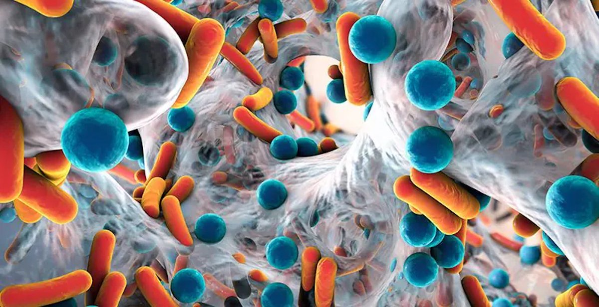 SponaugleWell's tweet photo. Biofilm causes the “waxing and waning” – or feeling better temporarily after receiving antibiotic therapy – that many chronic Lyme disease patients experience during the rollercoaster of IV antibiotics.

https://t.co/vYcs5cx3oK

#lymedisease #biofilm #bartonella #babesia https://t.co/TRR7X8P26i