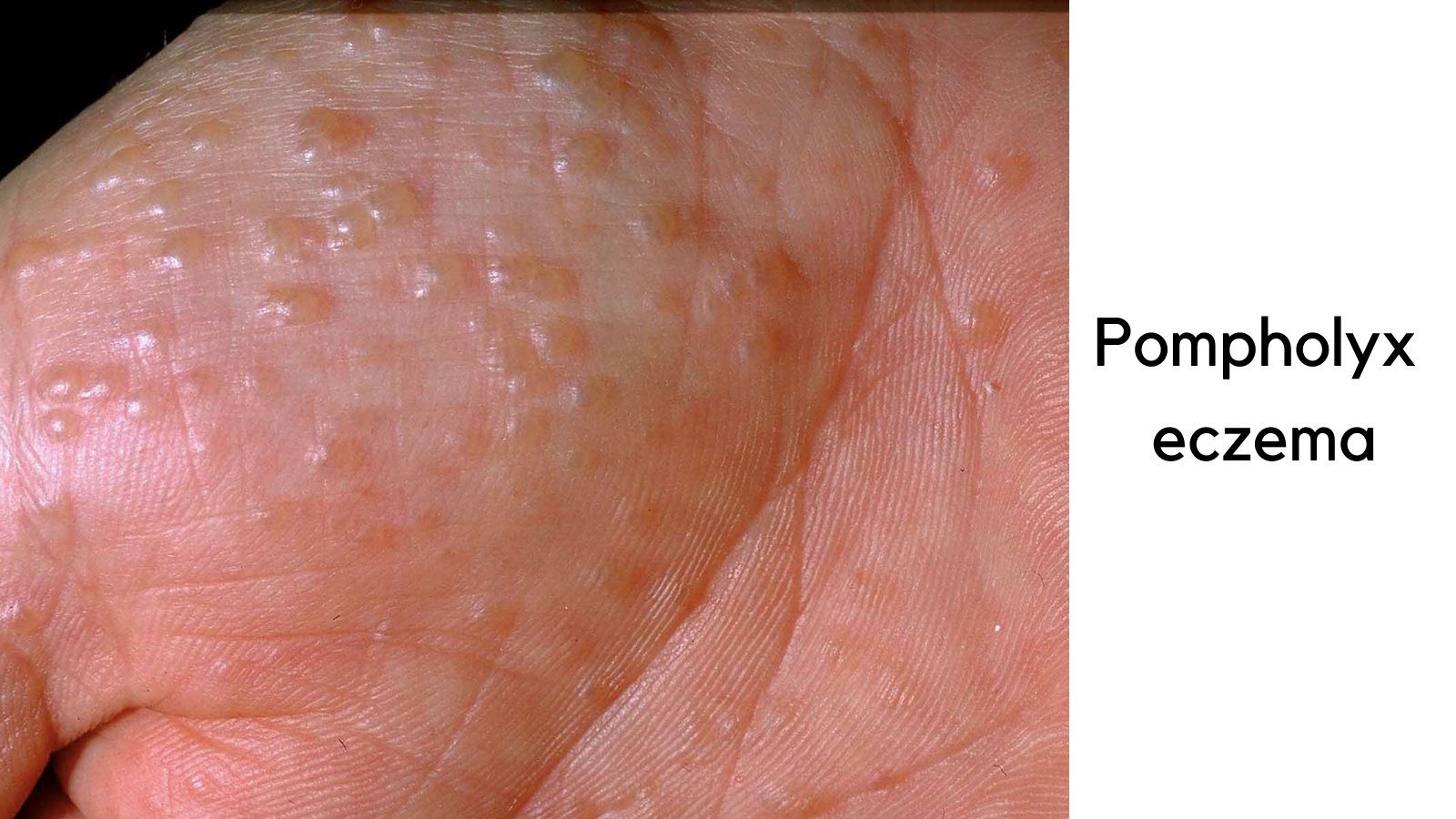 National Eczema Society (eczemasociety) / Twitter