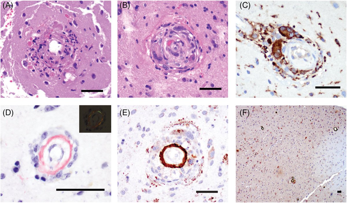 UNDER YOUR MICROSCOPE: A 53-year-old woman with a rapidly progressive, non-enhancing left frontotemporal lesion #neuropath <a href="/ColumbiaPath/">Columbia Pathology</a> 
Whole slide image: image.upmc.edu/NeuroPathology…

What's your diagnosis? Read the full case here: onlinelibrary.wiley.com/doi/10.1111/bp…