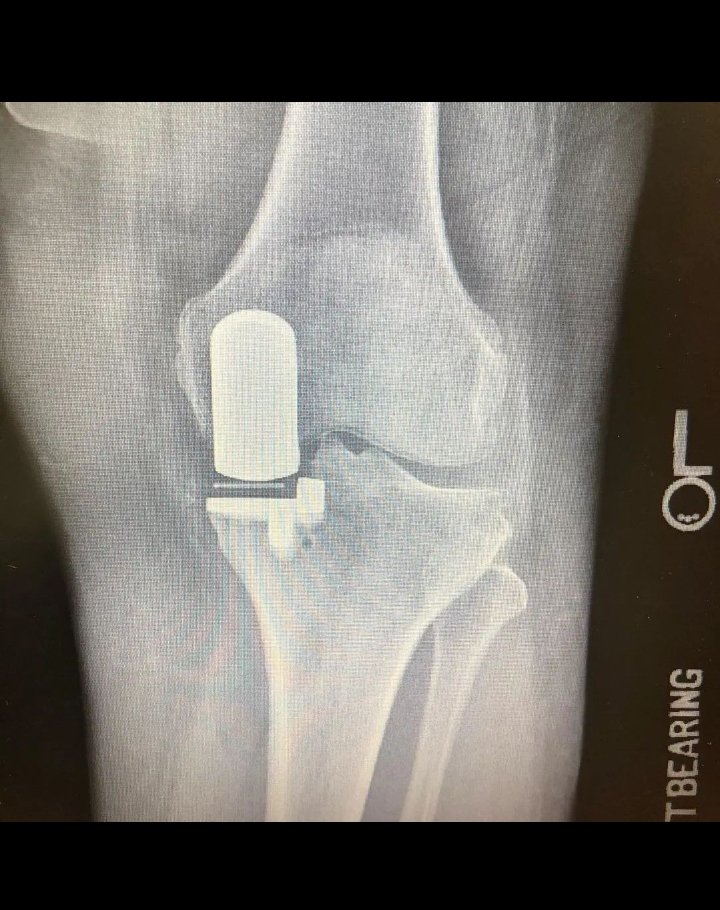 IfogahB's tweet photo. Forgot to upload the X-rays from this partial knee patient! Happy weekend!
.
 #orthopedicsurgery #orthosurgery #orthosurgeon #htown #htownrush #khou11 #fox26forlife https://t.co/fLoyn9Noky