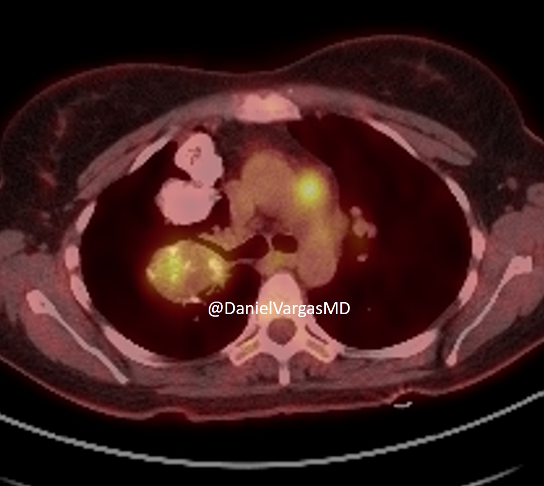Daniel Vargas, MD (@danielvargasmd) on Twitter photo I don't like pimping over twitter, but I will for this one
Young woman with remote history of gastrectomy
Why did she have a gastrectomy?
Answer will follow
#radres <a href="/RSNA/">RSNA</a> <a href="/thoracicrad/">Society of Thoracic Radiology</a> <a href="/atscommunity/">American Thoracic Society (ATS)</a> <a href="/jonherochung/">Jonathan Chung, MD</a> <a href="/TLHM_MD/">Tan-Lucien Mohammed, MD, FACR</a> <a href="/JoannaEscalonMD/">Joanna Escalon, MD</a> <a href="/svweisman/">Stacey Verzosa Weisman, MD</a> <a href="/LaurenGroner/">Lauren Kriger Groner</a> <a href="/LucyModahlMD/">Lucy Modahl</a> I don't like pimping over twitter, but I will for this one
Young woman with remote history of gastrectomy
Why did she have a gastrectomy?
Answer will follow
#radres <a href="/RSNA/">RSNA</a> <a href="/thoracicrad/">Society of Thoracic Radiology</a> <a href="/atscommunity/">American Thoracic Society (ATS)</a> <a href="/jonherochung/">Jonathan Chung, MD</a> <a href="/TLHM_MD/">Tan-Lucien Mohammed, MD, FACR</a> <a href="/JoannaEscalonMD/">Joanna Escalon, MD</a> <a href="/svweisman/">Stacey Verzosa Weisman, MD</a> <a href="/LaurenGroner/">Lauren Kriger Groner</a> <a href="/LucyModahlMD/">Lucy Modahl</a>