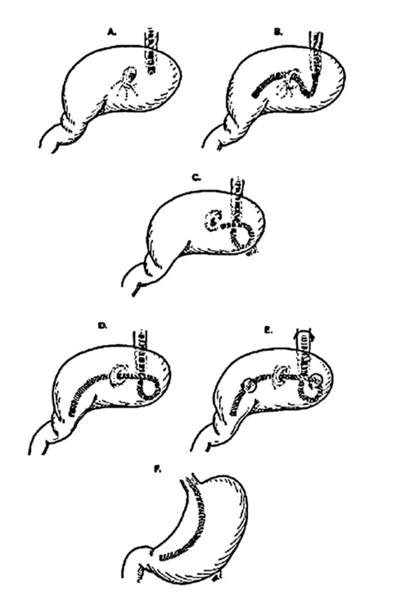 Keith siau on twitter the 6 steps for gastric volvulus detorsion a c
