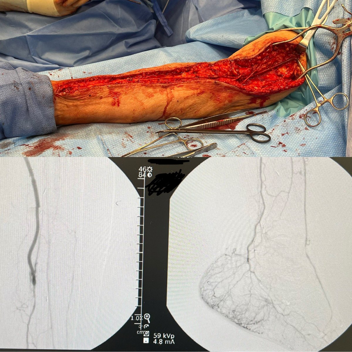 Octogenarian single segment non-reversed arm vein SFA-PT bypass, 3hr anesthesia time, palpable pulse #BESTCLI #loveagoodvein #comprehensivevascularcare #endofail