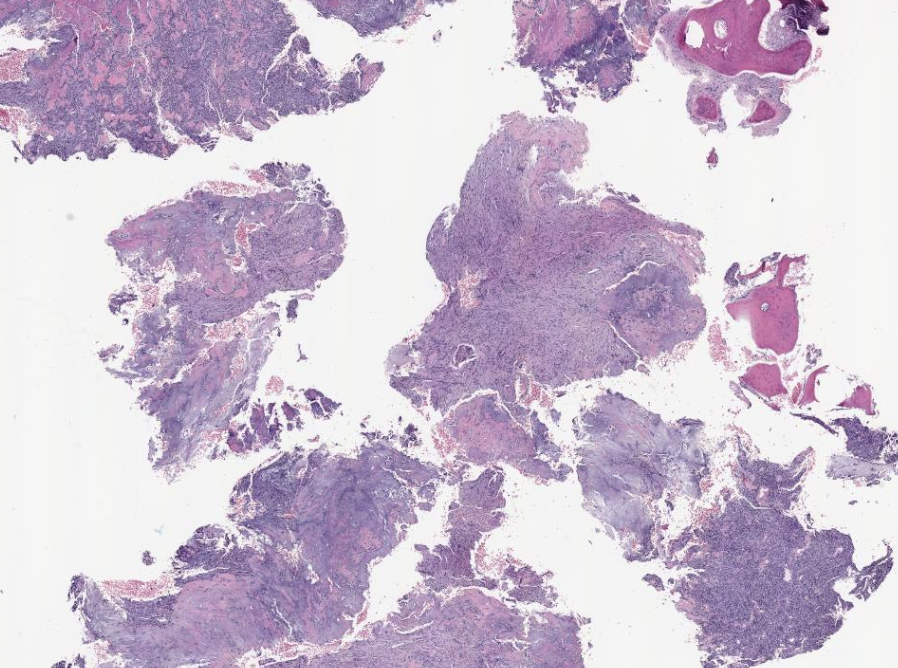 UChicagoPath's tweet photo. #IRAP22 Case 6 presented by PGY1 @ChandniDesai20
Middle aged male with right maxillary mass
Final dx: Phosphaturic mesenchymal tumor https://t.co/vkhLP1k9xC