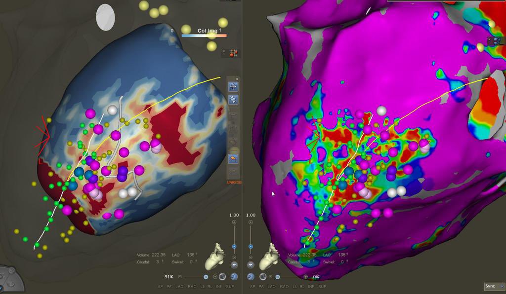 Cheryl Teres (@drcherylteresep) on Twitter photo Epicardial ablation of post myocarditis SMVT. Only one slow conducting huge channel as seen with <a href="/ADAS3D/">ADAS3D Medical</a> segmentation. Pink tag=hidden slow conduction unmasked by double extrastimuli. Green tag=phrenic capture what to do? #EPeeps #VTablation #CardiacImaging #CardioTwitter Epicardial ablation of post myocarditis SMVT. Only one slow conducting huge channel as seen with <a href="/ADAS3D/">ADAS3D Medical</a> segmentation. Pink tag=hidden slow conduction unmasked by double extrastimuli. Green tag=phrenic capture what to do? #EPeeps #VTablation #CardiacImaging #CardioTwitter