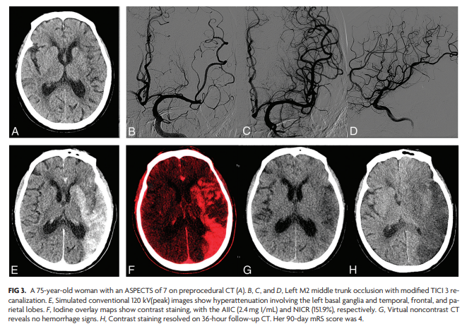 TheAJNR's tweet photo. "Quantitative Intracerebral Iodine Extravasation in Risk Stratification for Intracranial Hemorrhage in Patients with Acute Ischemic Stroke" #Stroke #IntracranialHemorrhage #DualEnergyCT #EditorsChoice | https://t.co/t7kZ06KwTB https://t.co/NSWopmxGFY