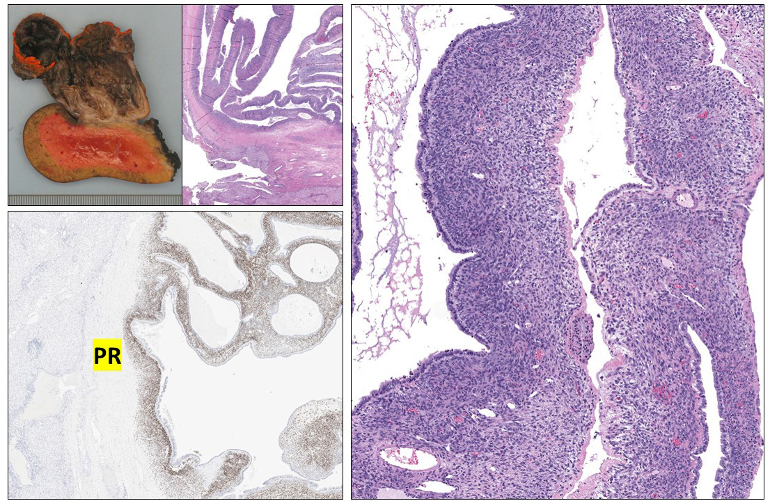 Mucinous cystic neoplasm (#MCN) is not specific to the #pancreas. It is seen in the #liver, too. Ovarian-type stroma is your clue. When in doubt, PR IHC would be helpful. Make sure to check if there is HGD or associated invasive carcinoma. This example only has LGD. @PathTwitter